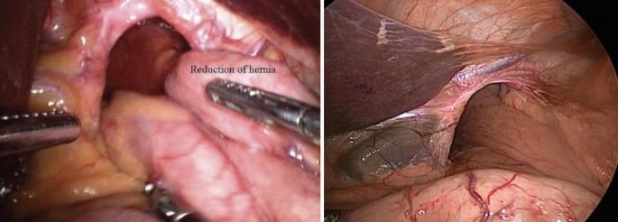 Laparoscopic Hiatal Hernia Repair with Nissen Fundoplication