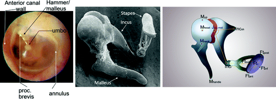 Artwork Of Prosthetic Stapes In Middle Ear Photograph by John