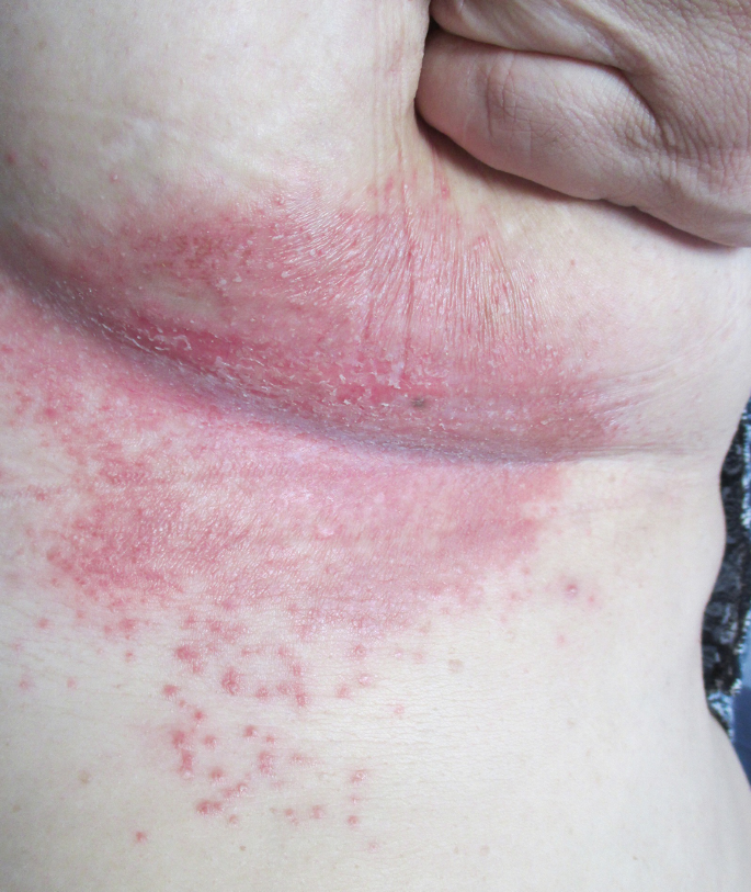 red rash under breasts