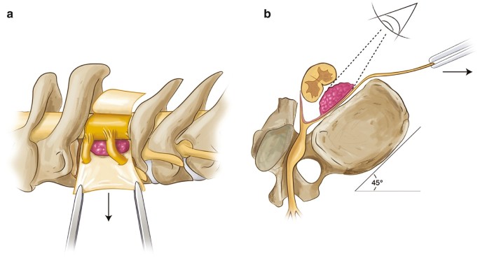 Surgical Techniques: Subaxial Cervical—Modified Subaxial Paramedian  Transpedicular Approach and Reconstruction