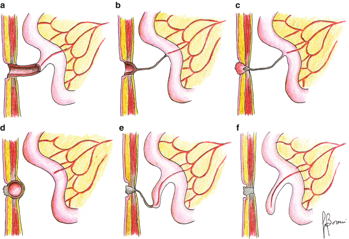 Omphalomesenteric Duct and Urachal Remnants | SpringerLink
