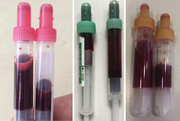 Patient Blood Management in Critically Ill | SpringerLink
