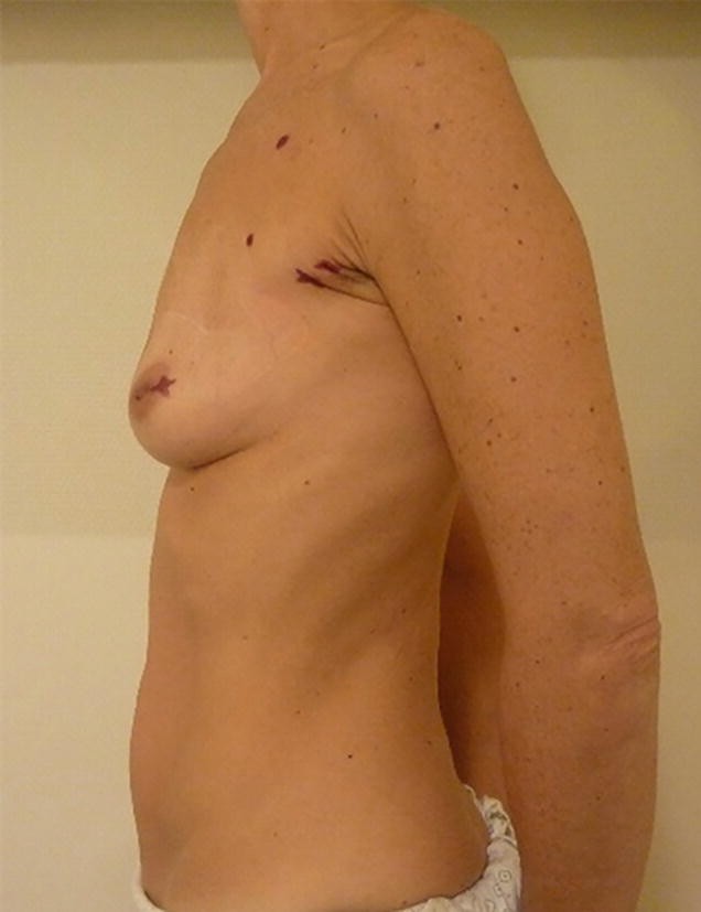A Transareolar incision was closing with Dermabond skin adhesive