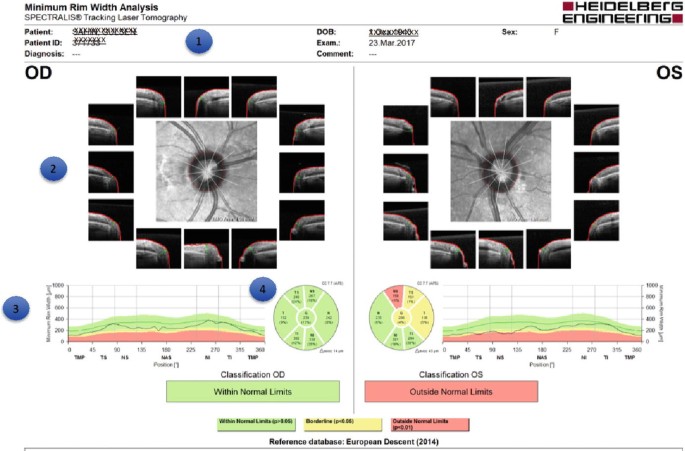 Interpretation of Imaging Data from Spectralis OCT | SpringerLink