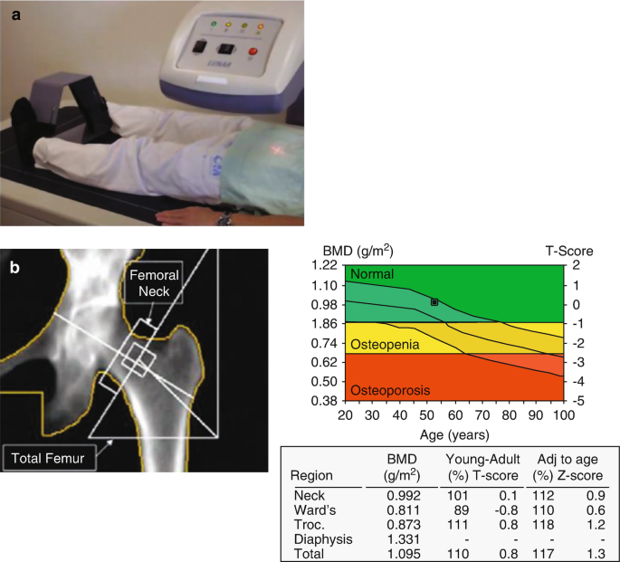 How Do DEXA Scans Work? The Science Behind Bone Mineral Density Tests