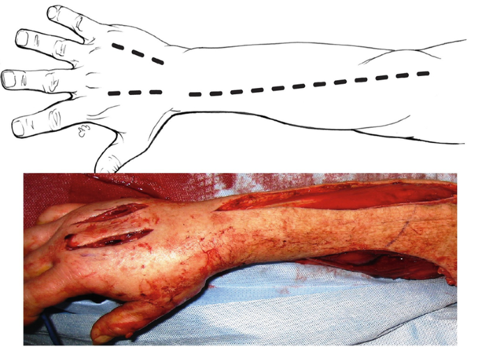 Extremity Compartment Syndrome (Chapter 10) - Color Atlas of