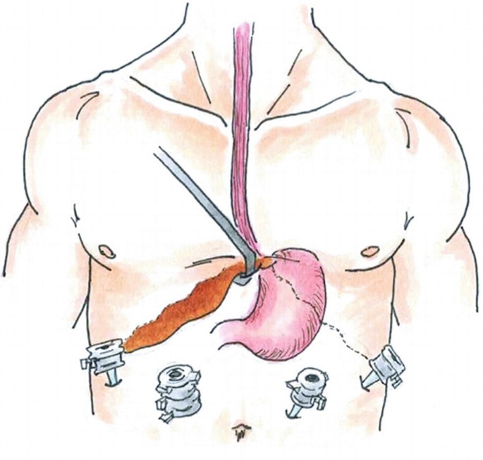 K Eckland – Thoracic Surgery