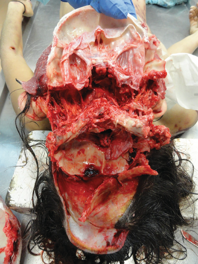 Lethal Traumatic Injuries due to Traffic Accidents | SpringerLink