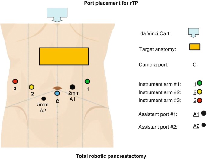 Port placement. A1, A2 two surgical assistant ports; C camera port; and