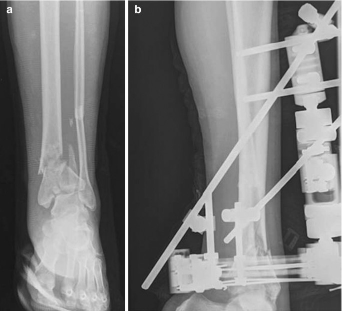 Full ring external fixation (Ilizarov) for Extraarticular, wedge fracture