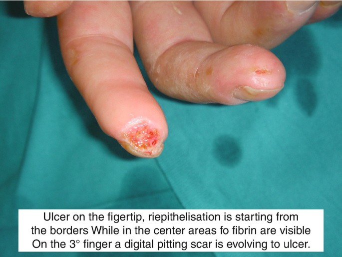 Atlas of Digital Ulcers and Lesions | SpringerLink
