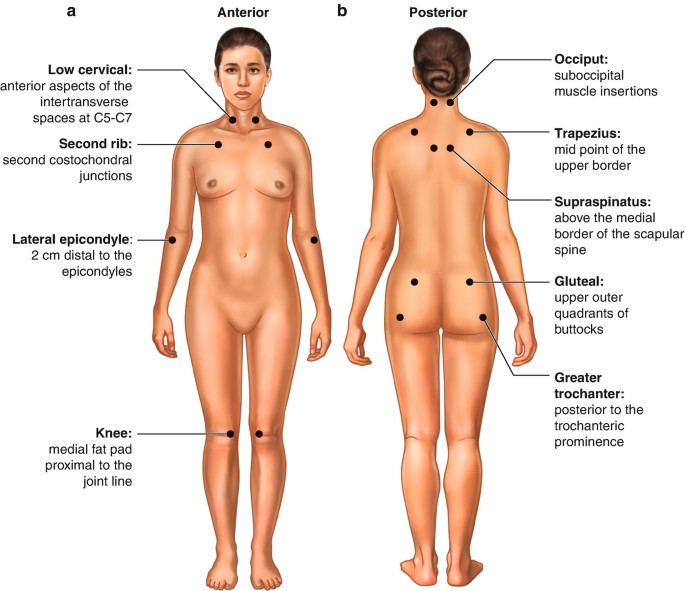 Fibromyalgia notable studies - MEpedia