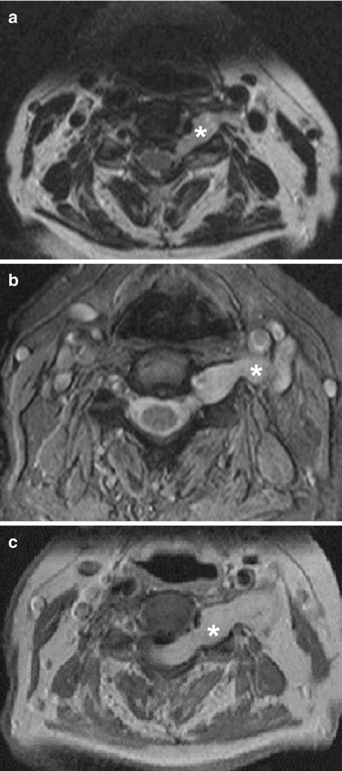 Dumbbell Tumors of the Spine | SpringerLink