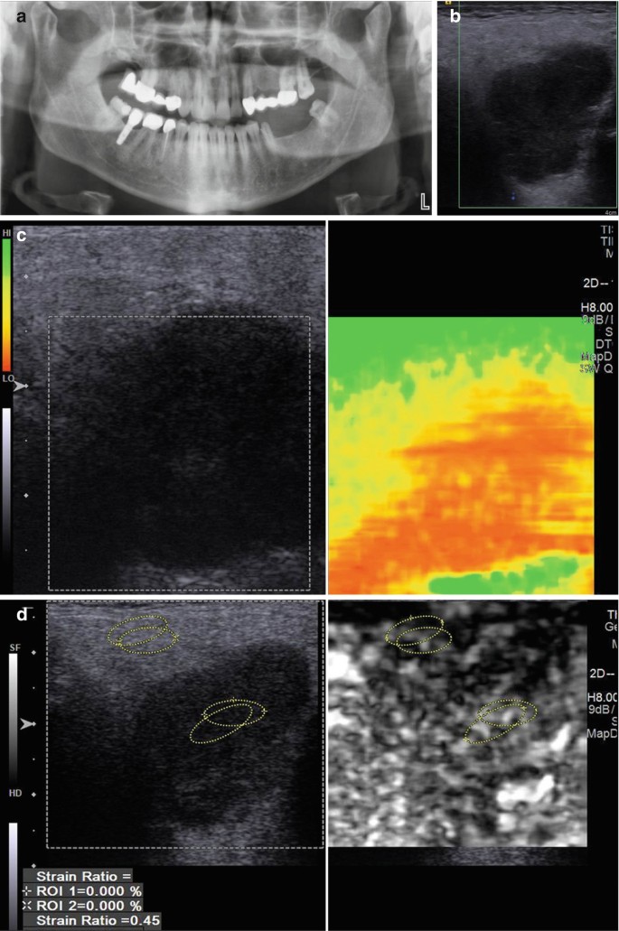 Incidental Findings in TMJ Imaging | SpringerLink