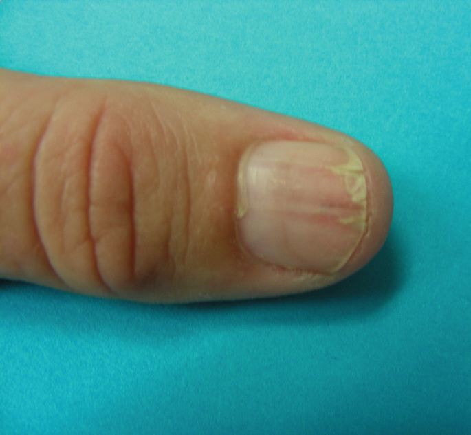 An Atlas of Nail Disorders, Part 6 | Consultant360