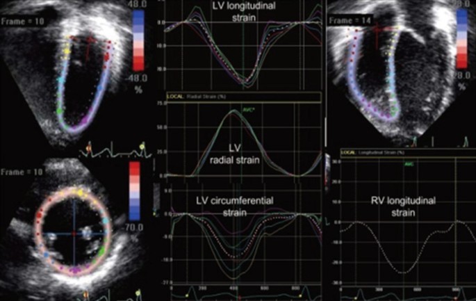 Speckle Tracking Echocardiography - an overview