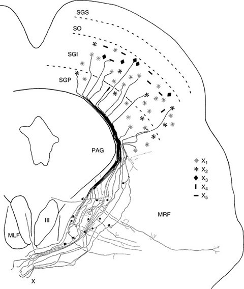 Topographic sketch. Coronal view of bilateral DRT (orange). Patient