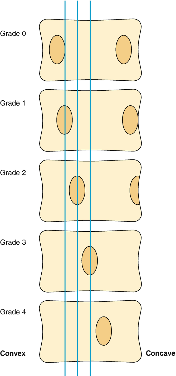 ما تصنيف ناش-مو (Nash-Moe Classification)؟
