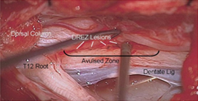 Radiofrequency Dorsal Root Entry Zone Lesions for Pain | SpringerLink