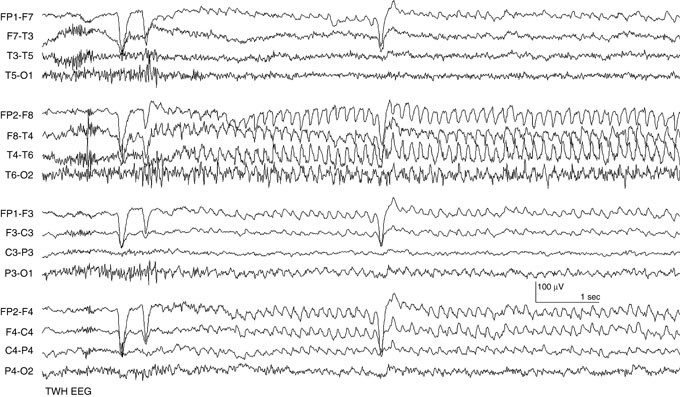 EEG in Epilepsy | SpringerLink