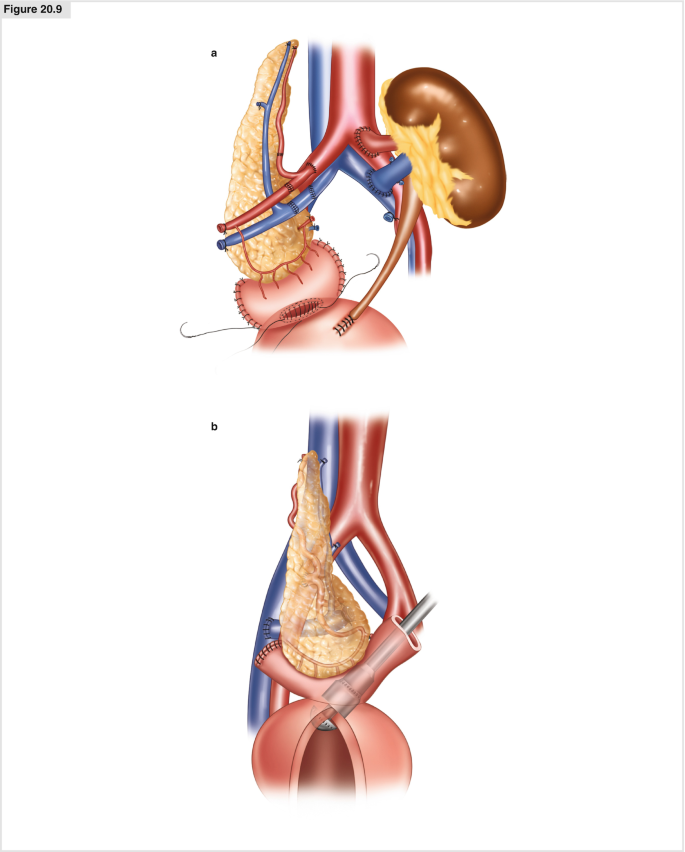 Pancreas Transplantation | SpringerLink