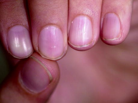 Top 10 reasons for brittle and deformed nails | TheHealthSite.com