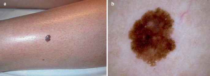 Cutaneous Malignant Melanoma