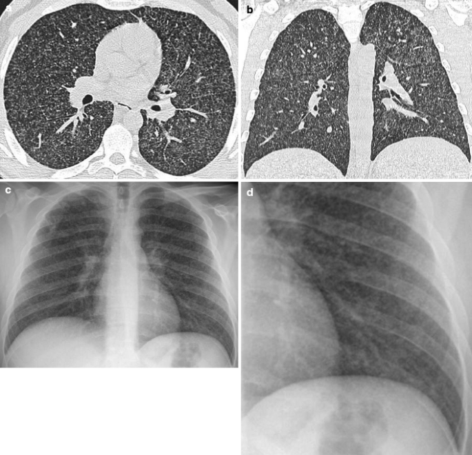 Interstitial Lung Disease | SpringerLink
