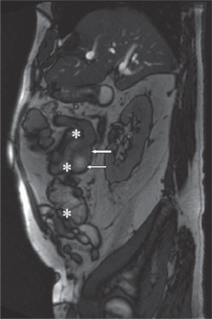 MRI of Adhesions Small Bowel Obstruction | SpringerLink