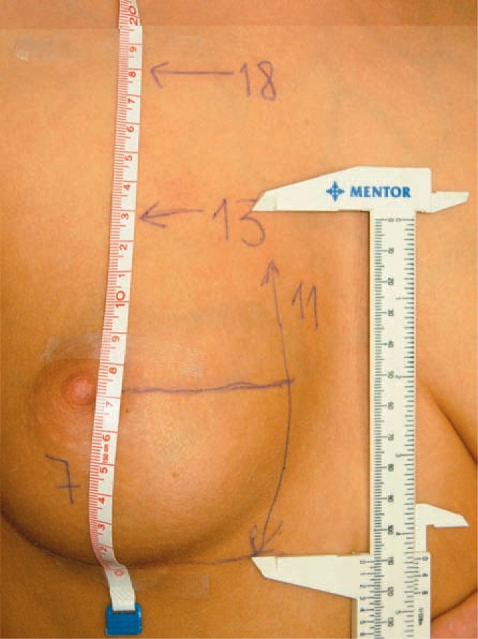 Breast Reduction Algorithm Using TTM Chart