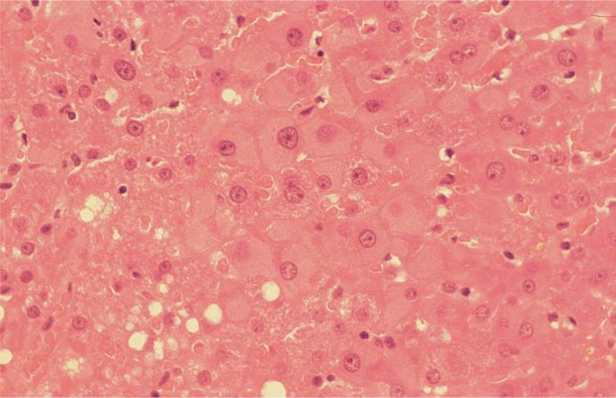 Basophilic viral inclusion body in the nucleus of a hepatocyte of one