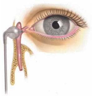 Minimally Invasive Lacrimal Surgery