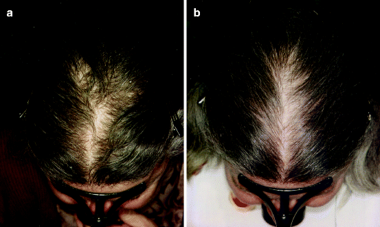 Age-Related General Problems Affecting the Condition of Hair | SpringerLink