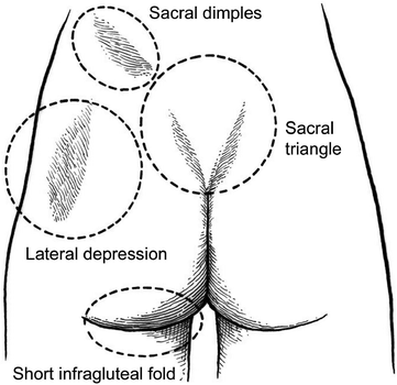 Gluteal Aesthetic Unit Classification