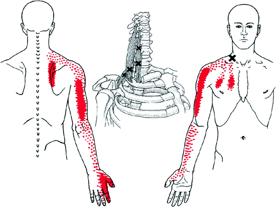 Myofascial Pain Syndrome | SpringerLink