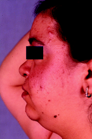 side effects of igf 1 lr3 Adverse Effects Encountered During IGF-I Treatment of Patients with Laron  Syndrome