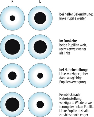 Pupille | SpringerLink