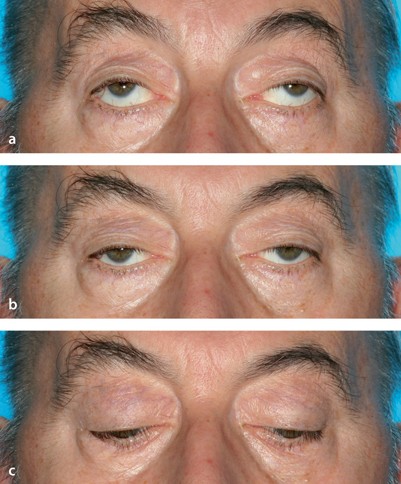 Augenmuskellähmung und supranukleäre Augenbewegungsstörung | SpringerLink