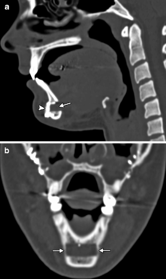 radiographie géniale du tubercule