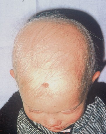Alopecia areata | SpringerLink