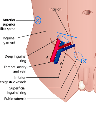 Objectives: ○ Abdominal hernias: ​​Inguinal hernias, Ventral hernias, Rare  external hernias, Internal hernias, Complicatio