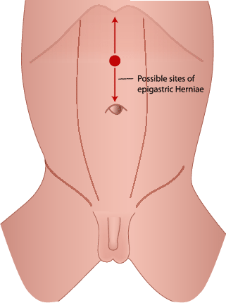 E9 Epigastric and Supra-umbilical Hernia Repair | SpringerLink