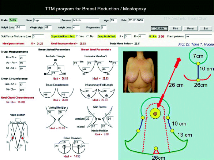 Vertical breast measurement in East Asian women: A guide for mastopexy and  reduction to form nonptotic breasts in unilateral prosthetic breast  reconstruction - ScienceDirect