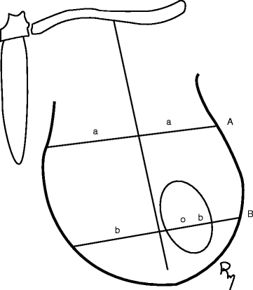 Modification of Moufarrege Total Posterior Pedicle Mammaplasty