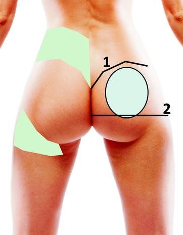 The ideal buttock: some aesthetic and morphometric considerations
