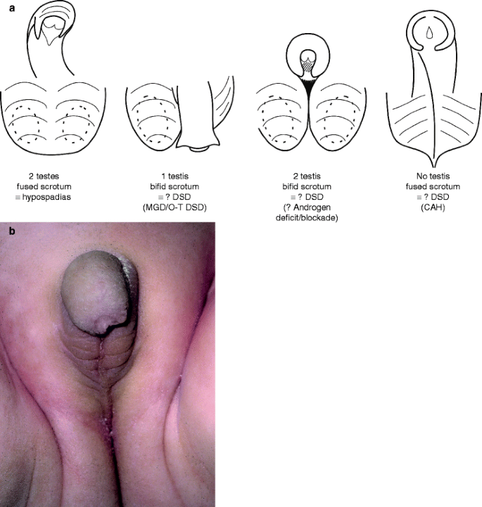 The Neonate with Ambiguous Genitalia | SpringerLink