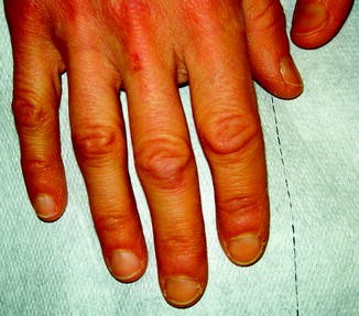 Skin Signs due to Self-Induced Vomiting | SpringerLink