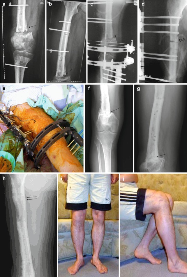 Patient with tibia nonunion. a X-ray from the pre-treatment period