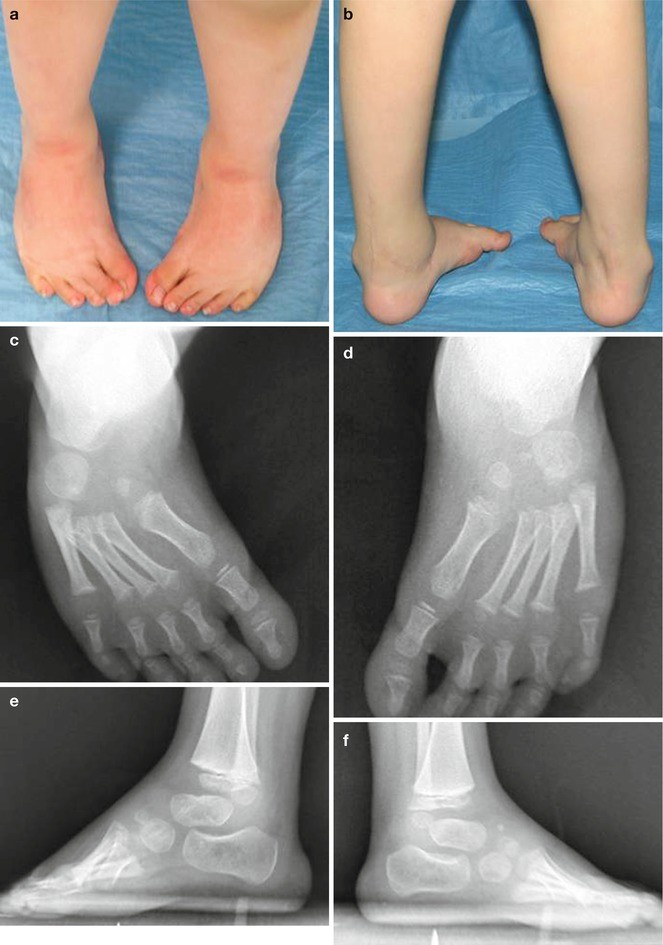 Management Of Clubfoot Springerlink