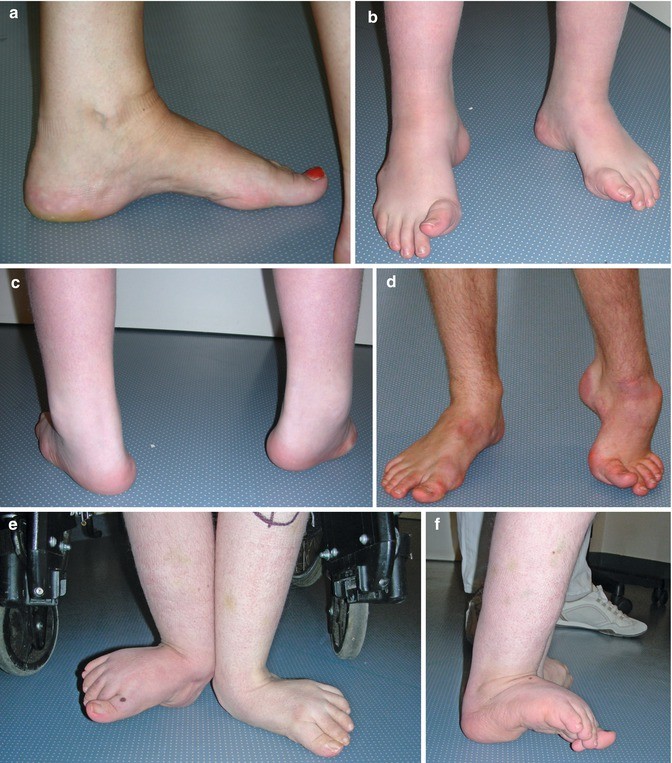 z foot deformity